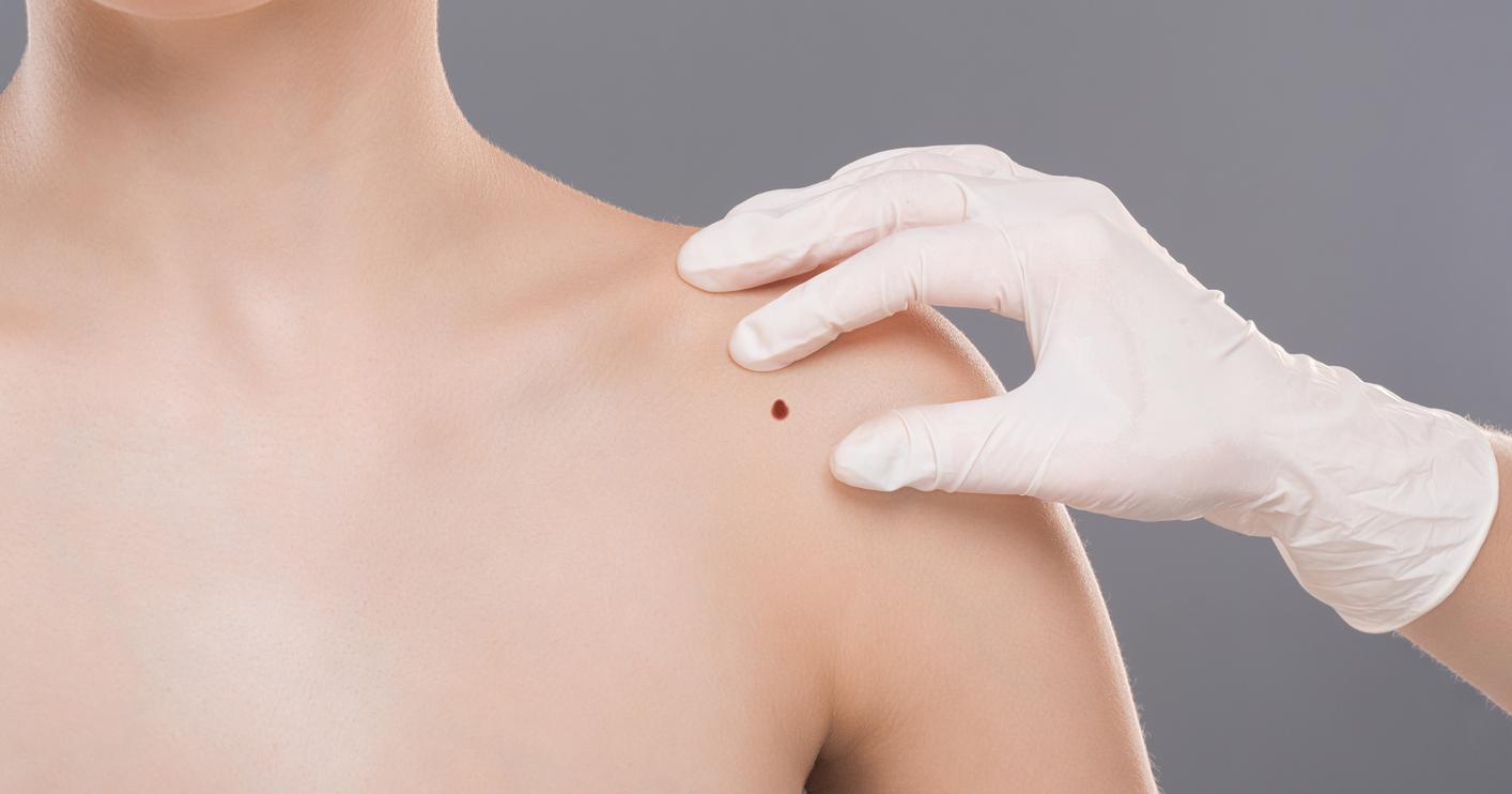 Skin Cancer Prevention Tips From a Two-time Survivor and Top Medical Experts