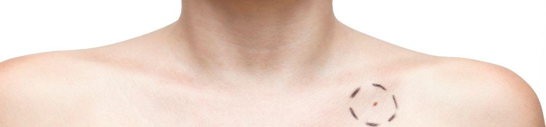 Meet The Painless, Surgery-Free Sticker That Helps Detect Skin Cancer