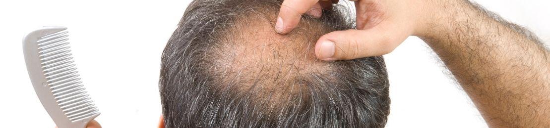 The Best Treatments for Men’s Hair Loss, According to a Leading Dermatologist