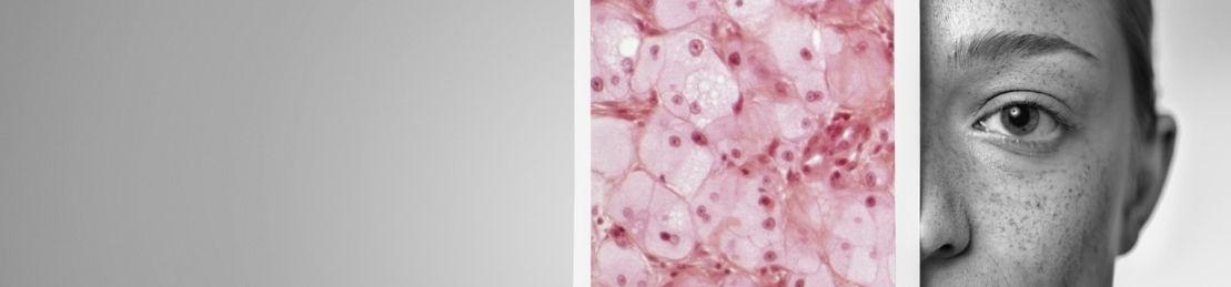 Why Ignoring That Tiny Freckle Could Be Deadly - A Skin Cancer Survivor Reveals Her Story