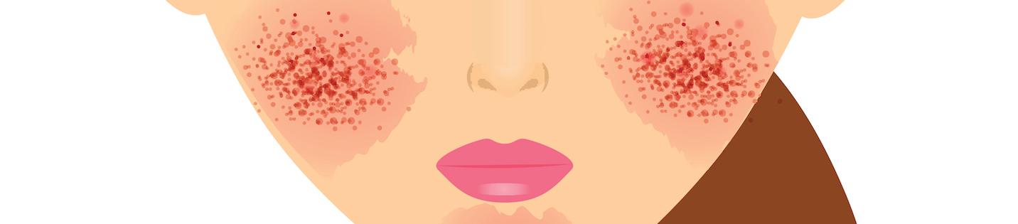Over-exfoliation 101: How to Recognize the Signs & What to Do About It