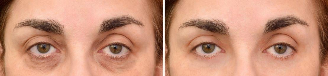 Get Younger Looking Eyes Without Surgery Thanks To This New FDA-Approved Solution